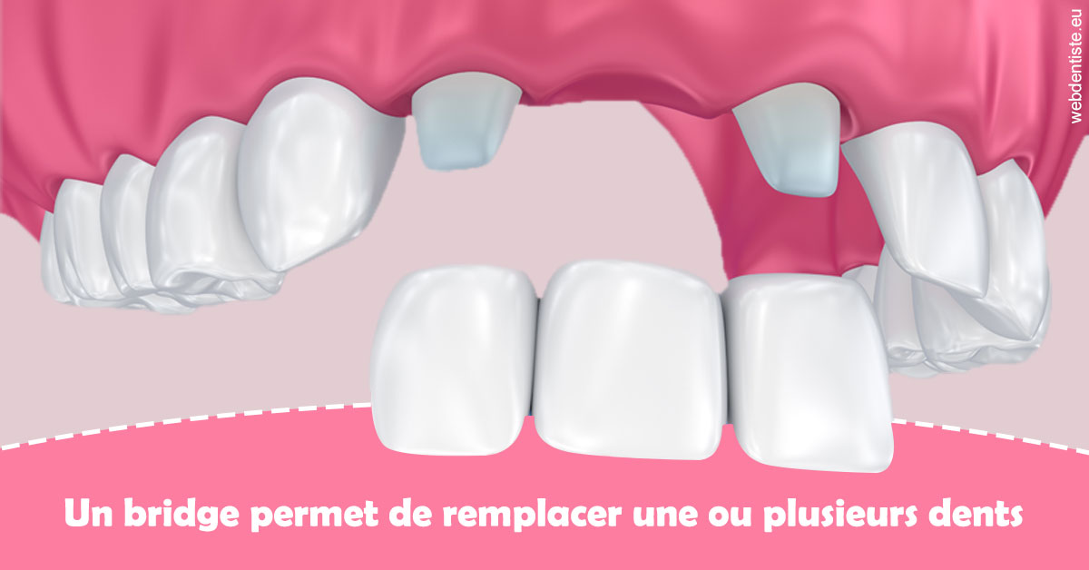 https://www.cabinetdocteursrispalmoussus.fr/Bridge remplacer dents 2