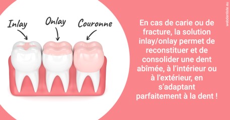 https://www.cabinetdocteursrispalmoussus.fr/L'INLAY ou l'ONLAY 2