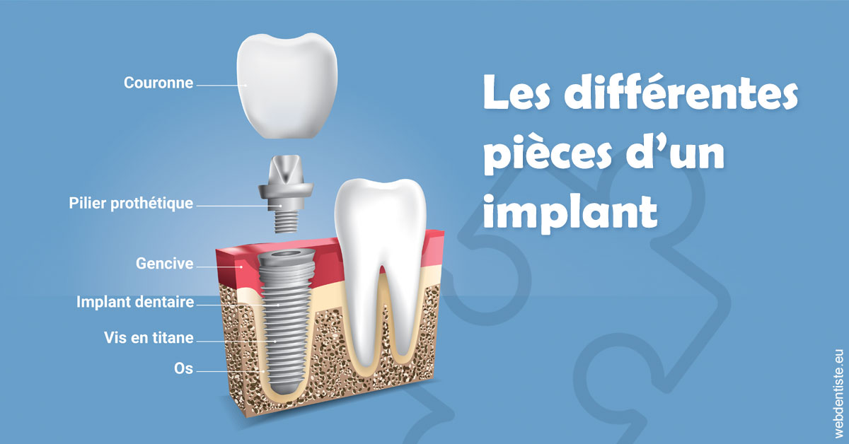 https://www.cabinetdocteursrispalmoussus.fr/Les différentes pièces d’un implant 1